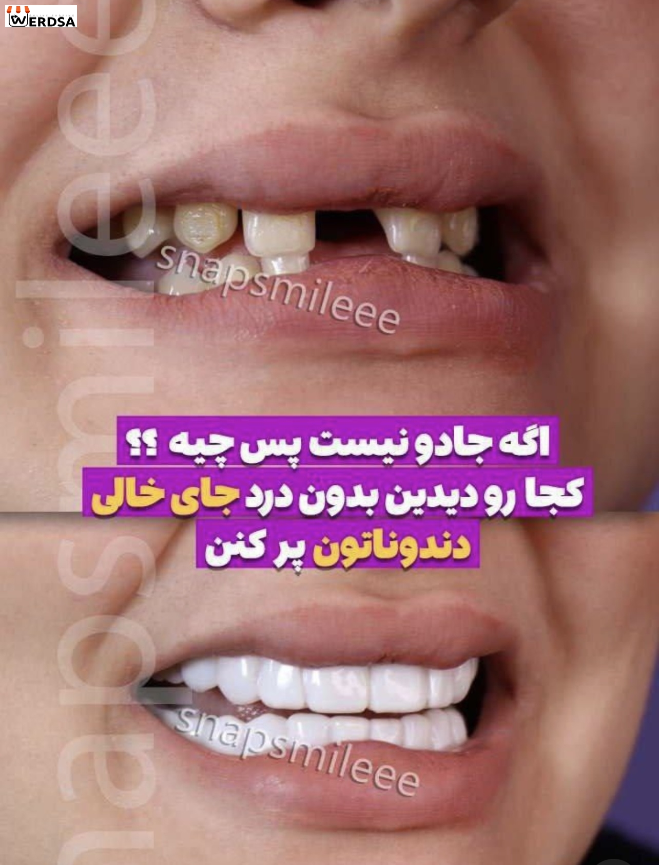 خمیر ترو اسمایل دو فک بدون قالب حجم متوسط مناسب 4 دندان خراب
